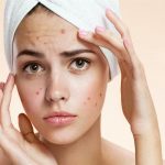 هل تعاني من البثور المزعجة طرق سريعا لتخلص منها؟