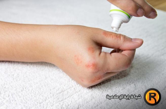 فلسطينية تحصل على براءة اختراع لمرهم يعالج الأكزيما