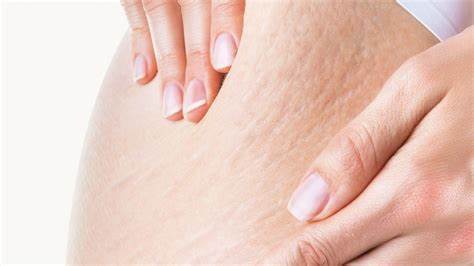 لماذا يظهر السيلوليت عند النساء أكثر من الرجال ؟